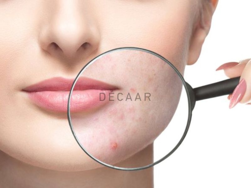 Điều trị mụn thông thường